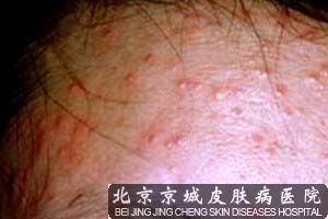 毛囊炎如何治疗