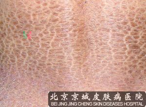 鱼鳞病的症状有哪些
