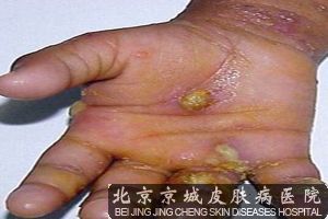该如何预防感染疥疮
