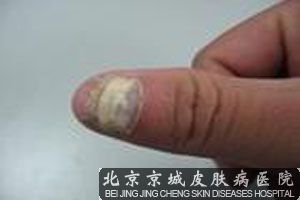 走出认识误区， 灰指甲