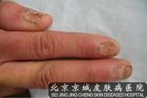 传统治疗灰指甲的方法分析