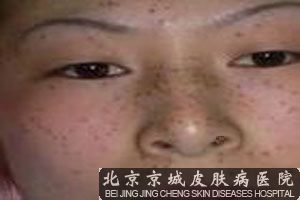 雀斑患者的形成因素及分类