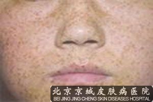 雀斑对于患者造成的影响介绍 