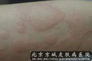 荨麻疹的主要发生原因介绍