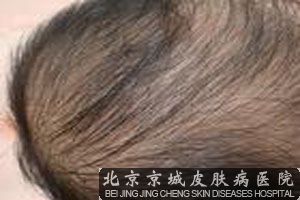 女性出现脱发的原因介绍