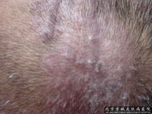 如何预防脂溢性皮炎患者脱发