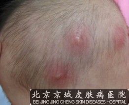 为了方便患者到院就医，北京京城皮肤医院开通了网上挂号、网上预约挂号!患者只要通过网上就能的挂号，到院就能直接的与医生一对一的交流检查!