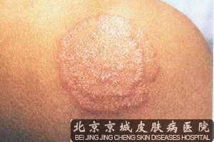体癣的防护措施有哪些