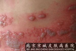 带状疱疹要如何治疗