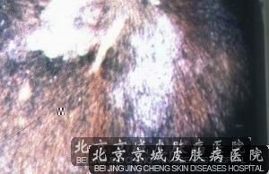 头癣会传染吗