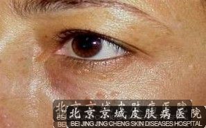 汗管瘤要怎么诊断