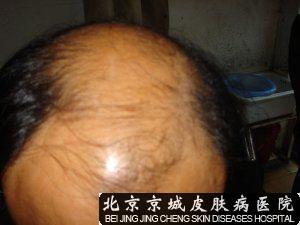 男性型脱发患者的临床症状表现