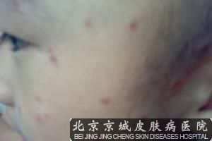 丘疹性荨麻疹严重吗