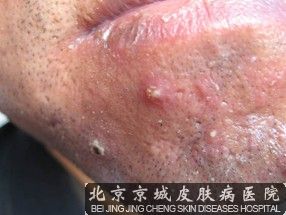 该如何饮食才能有助于毛囊炎的治疗