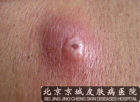  毛囊炎把握时间是关键