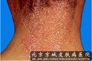 神经性皮炎的发病原因是什么