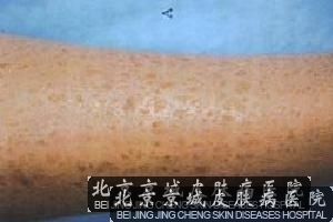 鱼鳞病是怎么遗传给下一代的