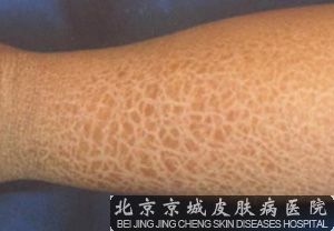鱼鳞病患者可以结婚生孩子吗