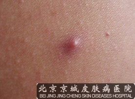 中西医是如何看待毛囊炎的病因