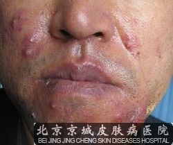 毛囊炎的危害有哪些