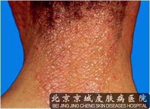 中医分析神经性皮炎的病因