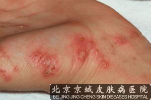 疥疮引起皮肤损害的原因有哪些