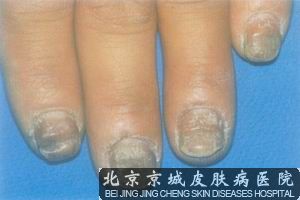 灰指甲的发病原因