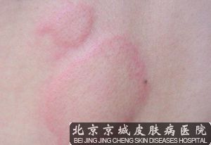 皮肤病医院治疗慢性荨麻疹
