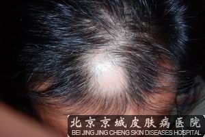 斑秃的治疗方法