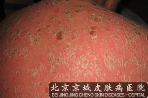 牛皮癣的发病原因是什么