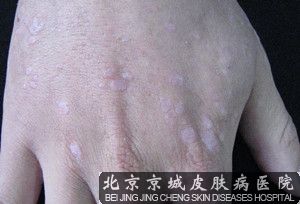 治疗扁平疣*的方法