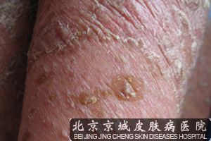 牛皮癣反复发作的原因