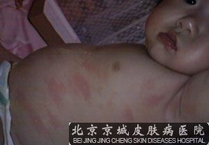 小儿荨麻疹怎么护理