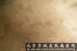 治疗扁平疣的偏方