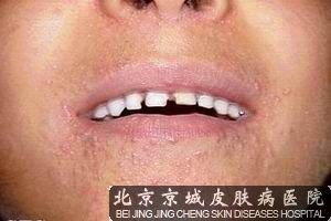 口周皮炎的症状是什么