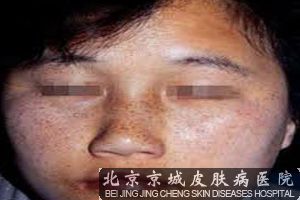 祛除色斑*的方法