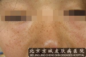 雀斑怎么去除