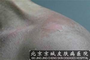 太阳晒伤怎么办
