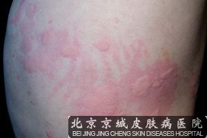 寒冷性荨麻疹偏方
