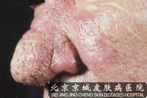 治疗酒糟鼻的药