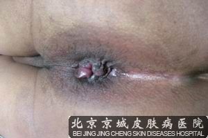 肛周湿疹怎么治疗