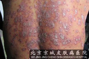 牛皮癣是怎样得的