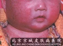 儿童牛皮癣是什么原因引起的