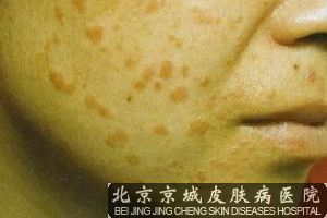 扁平疣怎样治疗*