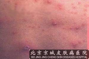 过敏性紫癜能自愈吗