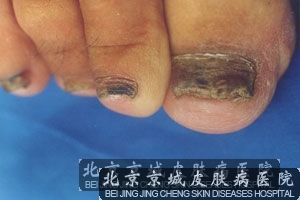 灰指甲有哪些护理措施