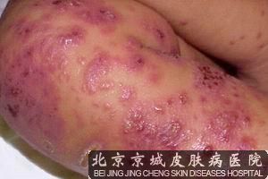 慢性湿疹的症状是什么样的
