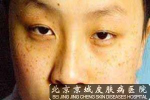 雀斑的治疗方法