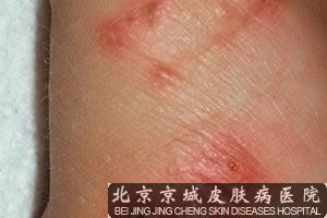 儿童疥疮怎么及早发现