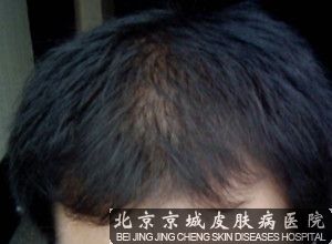 为什么会脱发